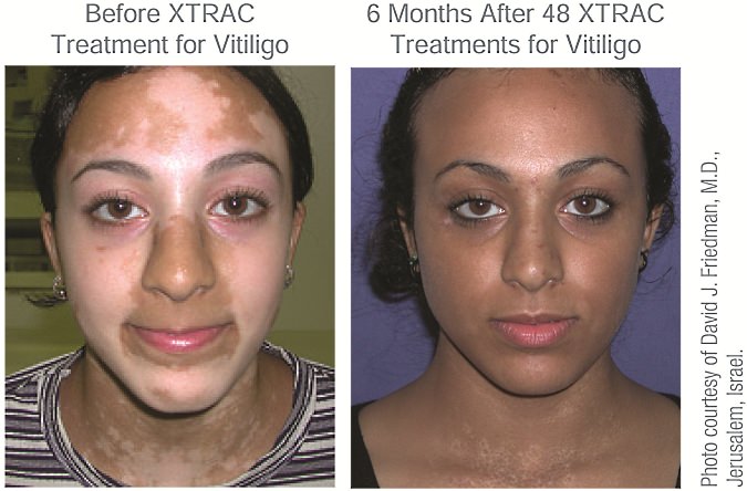 Before XTRAC Treatment and After XTRAC Treatment for Vitiligo Adult