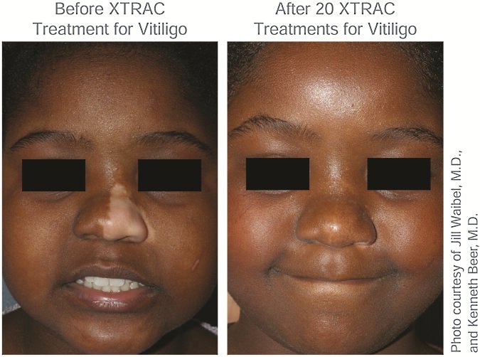 Before XTRAC Treatment and After XTRAC Treatment for Vitiligo Child