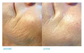 Micro-needling Rejuvapen Micro-needling Rejuvapen